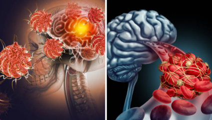 Brain Stroke: वेळीच स्ट्रोकची लक्षणे ओळखल्यास वाचू शकतो अमूल्य जीव, तज्ज्ञांचा खुलासा
