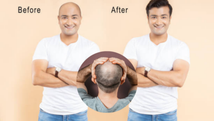 20 दिवसात तुळतुळीत टकलावर येतील घनदाट केस, ‘या’ देशाच्या वैज्ञानिकांचा दावा; ‘टक्कल पडण्यावर कायमचा उपाय’