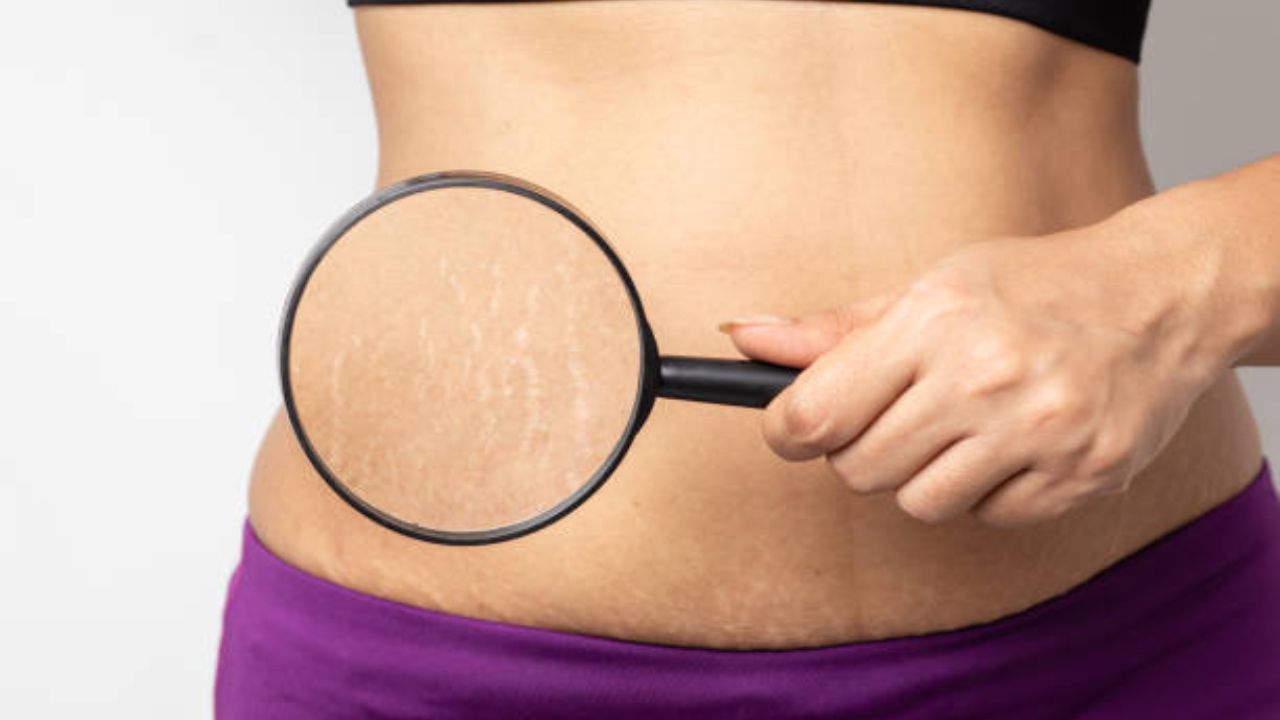 प्रेगनेंसी नंतरच्या Stretch Marks ने हैराण झालात? मग आता टेन्शन सोडा आणि या घरगुती उपायांचा वापर करा