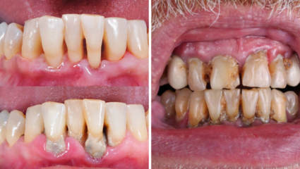 Teeth Whitening: दातांवर चढलाय पिवळट थर, मोत्यांसारख्या दातांसारखी ‘देशी’ जुगाड; तज्ज्ञांचा सोपा उपाय