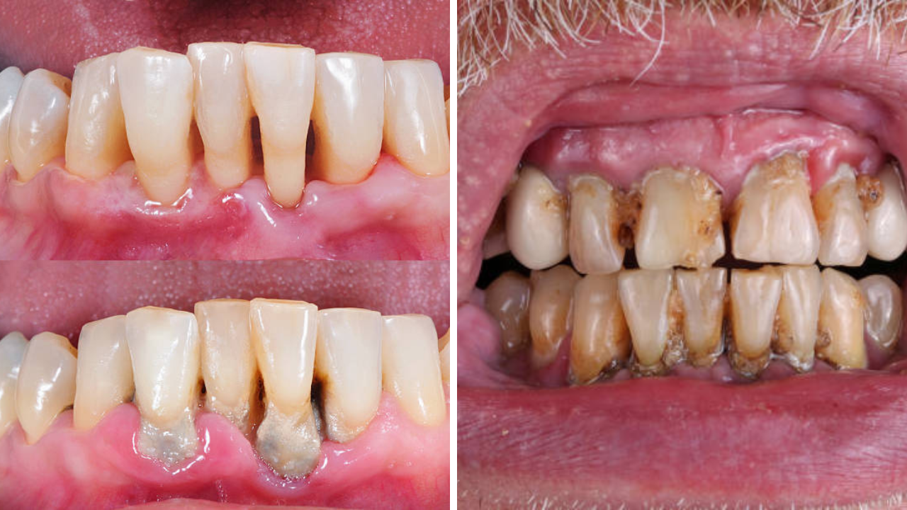 Teeth Whitening: दातांवर चढलाय पिवळट थर, मोत्यांसारख्या दातांसारखी ‘देशी’ जुगाड; तज्ज्ञांचा सोपा उपाय