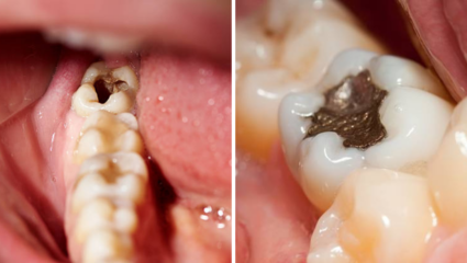 Cavity In Teeth: दातात वळवळणारा काळा किडा, सडण्यापासून वाचेल जबडा, 5 सोपे उपाय कराच