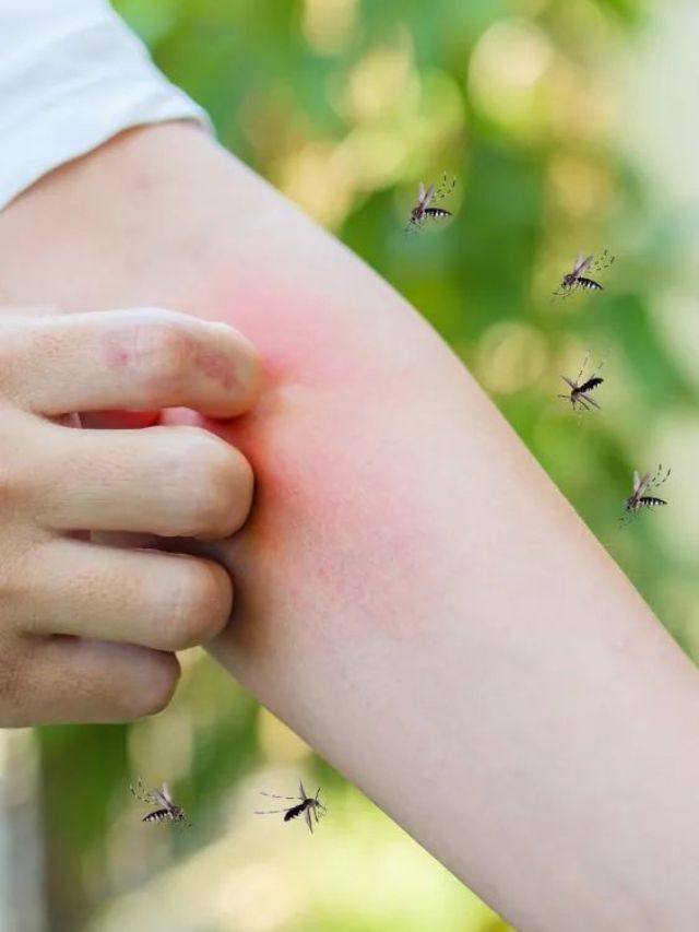 डास चावल्याने होते जळजळ, करा हे उपाय