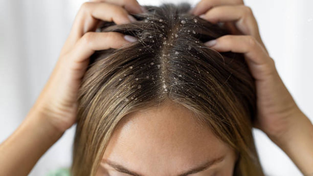 थंडीत केसांमध्ये खूप जास्त कोंडा झाला आहे? मग 'या' पद्धतीने करा कोरफडचा वापर