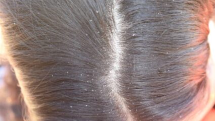 थंडीत केसांमध्ये वाढलेल्या कोंड्यामुळे त्रस्त झाला आहात? मग शेवग्याच्या पानांमध्ये मिक्स करा ‘हे’ पदार्थ, महिनाभरात होईल केसांची