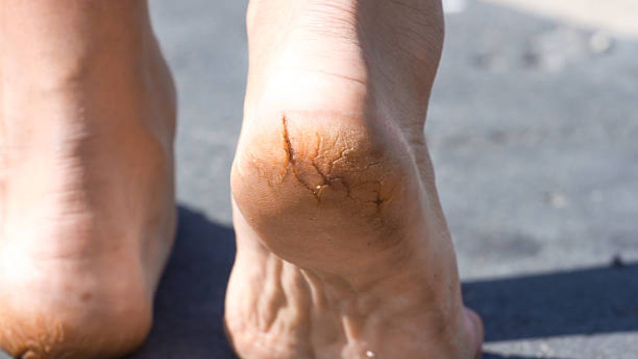 पायांच्या टाचांना पडलेल्या भेगा कायमच्या होतील नष्ट! १० रुपयांच्या तुरटीचा ‘या’ पद्धतीने करा वापर, त्वचा होईल मुलायम