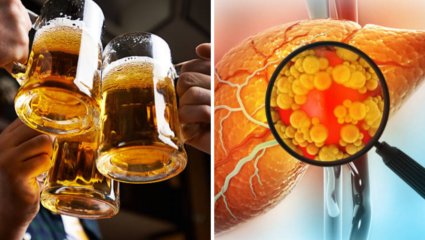 ‘Beer पण दारूच आहे अमृत नाही’..रुग्णाला Liver डॉक्टरचे खरमरीत उत्तर, लिव्हर सडण्याआधी वाचाच