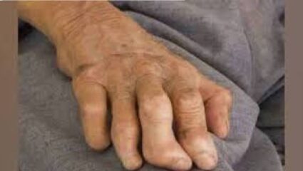 राज्यात कुष्ठरोग शोध अभियान! १७ नोव्हेंबर ते २ डिसेंबर दरम्यान घरोघरी तपासणी