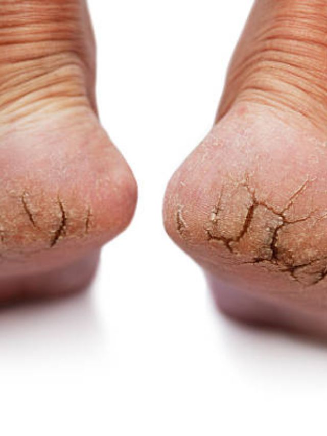 टाचांच्या भेगांनी आहात हैराण, या घरगुती टिप्स वापरा