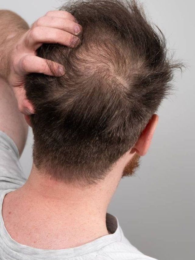 हे 4 पदार्थ खाणं आजच बंद करा, नाहीतर टक्कल पडेल