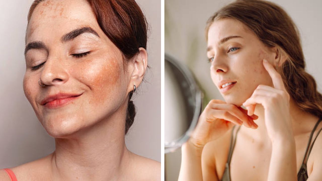 ना क्रीम ना औषध… फक्त 7 दिवसांत चेहऱ्यावरील सर्व डाग, पिगमेंटेशन होईल दूर; 5 रुपयांचा हा उपाय करा आणि कमाल पहा