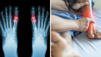 Uric Acid च्या रुग्णांनी टाळा 3 भाज्यांचे सेवन, संधिवाताने व्हाल हैराण