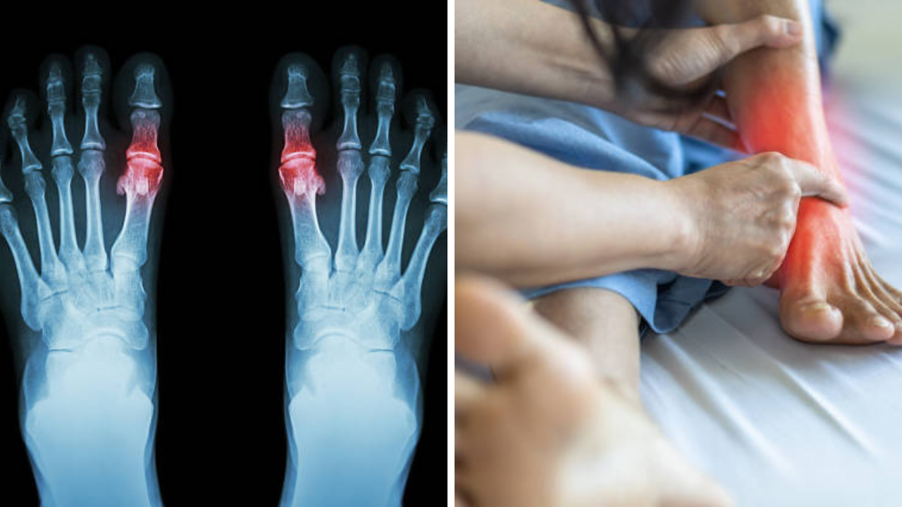 Uric Acid च्या रुग्णांनी टाळा 3 भाज्यांचे सेवन, संधिवाताने व्हाल हैराण