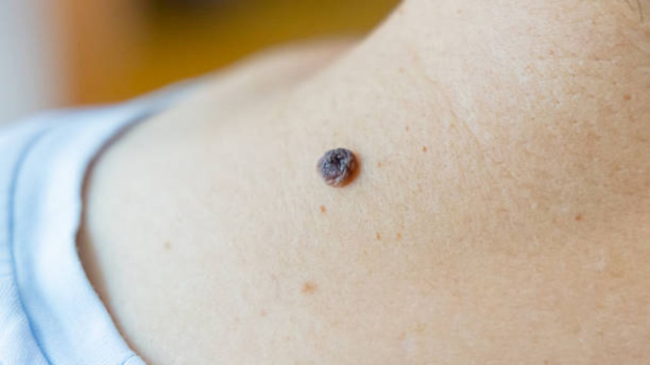 Birth Mark: शरीरावरील जन्मखुणांचा पूर्वजन्माशी काय आहे संबंध, जाणून घ्या पूर्वजन्माशी असलेले नाते