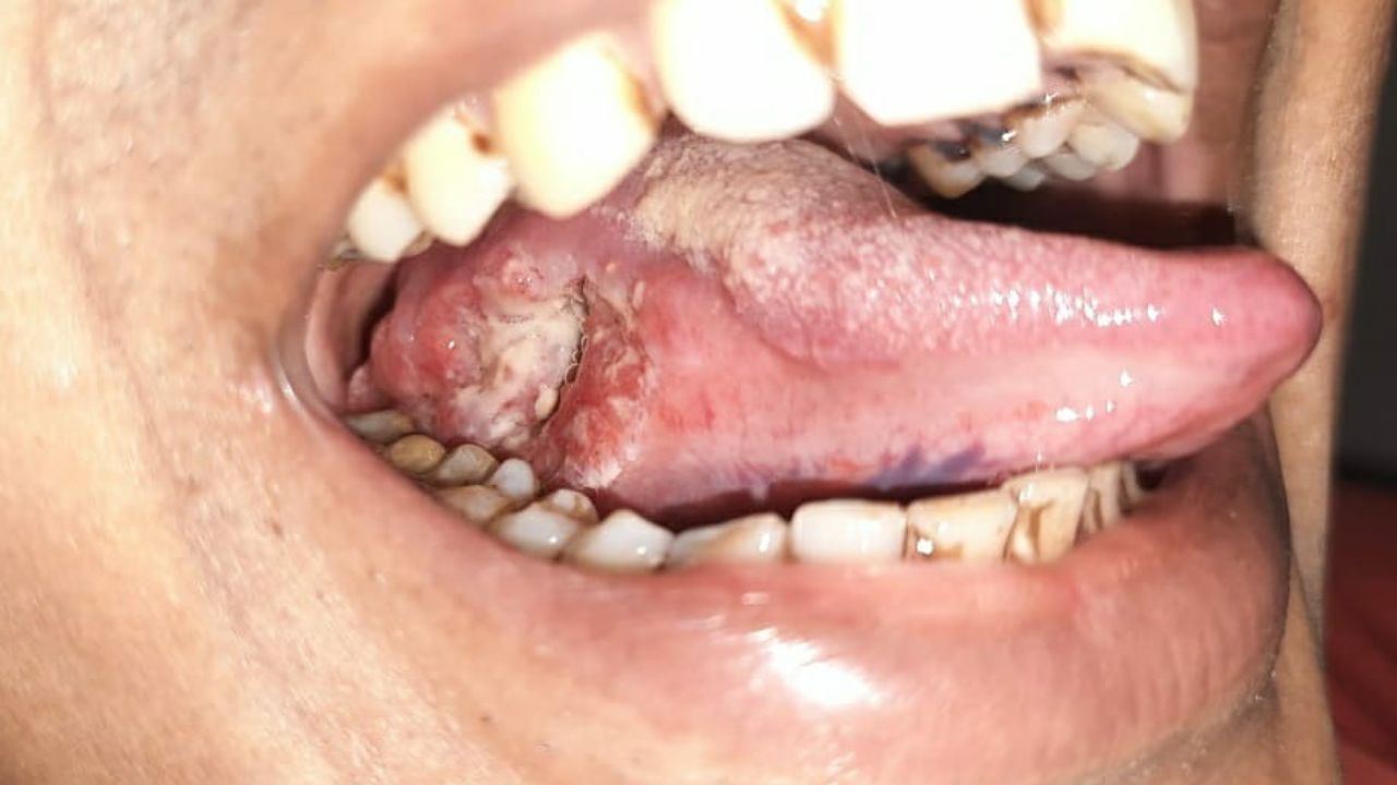 Oral cancer Risk : महुआ, खर्रा, ताडीचे मद्य सुरक्षित नाही; तोंडाच्या कर्करोगाचा धोक्यात 45 टक्क्यांनी वाढतो