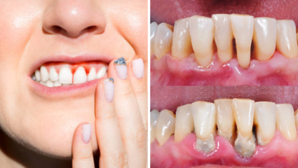 Periodontitis: जबडा सडवू शकतो ‘हा’ आजार, 32 दात तुटण्याआधी त्वरीत करा 5 कामं