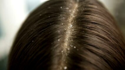 केसांमध्ये वाढलेला कोंडा सतत खांद्यावर पडतो? वाटीभर खोबऱ्याच्या तेलात मिक्स करा ‘हा’ पदार्थ, कोंडा होईल कायमचा कमी