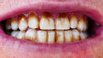 तंबाखू- गुटखा खाऊन सडलेले दात पांढरेशुभ्र करण्यासाठी ‘या’ आयुर्वेदिक पदार्थांचा करा वापर, १० रुपयांमध्ये होतील चमकदार दात