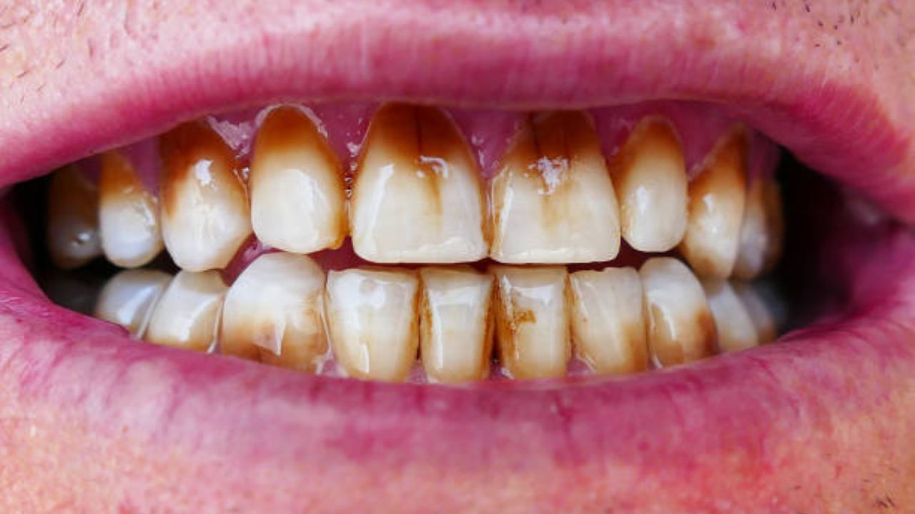 तंबाखू- गुटखा खाऊन सडलेले दात पांढरेशुभ्र करण्यासाठी ‘या’ आयुर्वेदिक पदार्थांचा करा वापर, १० रुपयांमध्ये होतील चमकदार दात