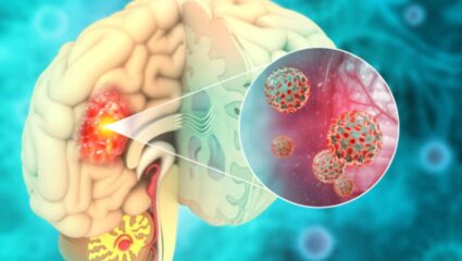 डोकेदुखीमुळे हैराण झाला आहात? मेंदूच्या कँन्सरची लागण झाल्यानंतर दिसून येतात ‘ही’ महाभयंकर लक्षणे, दुर्लक्ष केल्यास होईल मृत्यू