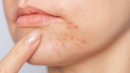 पिंपल्स मुरुमांचे डाग होतील कायमचे नष्ट! संत्र्याच्या सालीचा ‘या’ पद्धतीने करा वापर, चेहऱ्यावरील येईल सोन्यासारखी चमक