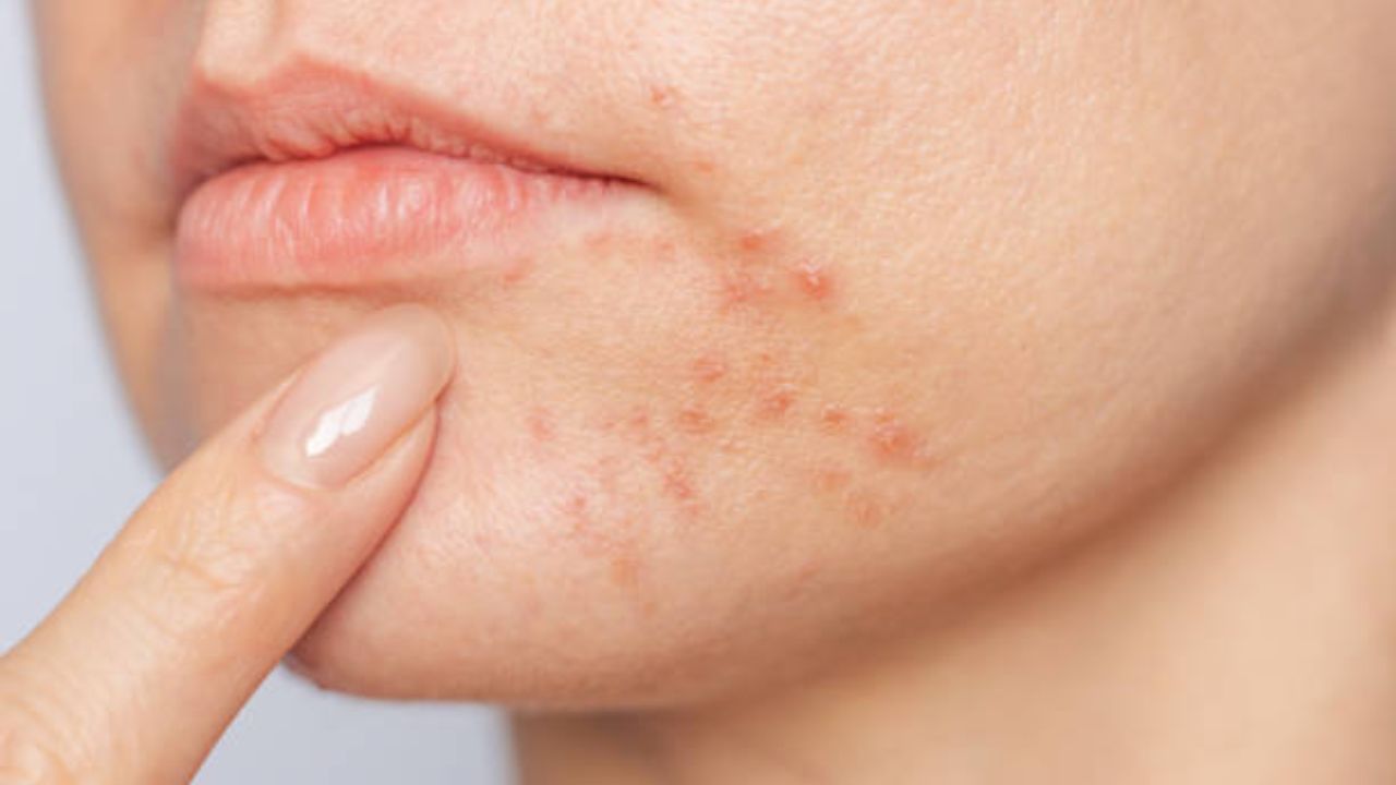 पिंपल्स मुरुमांचे डाग होतील कायमचे नष्ट! संत्र्याच्या सालीचा ‘या’ पद्धतीने करा वापर, चेहऱ्यावरील येईल सोन्यासारखी चमक