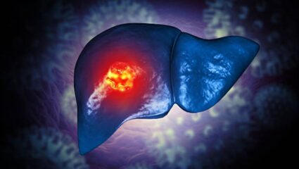 डोळ्यांमध्ये वाढलेल्या पिवळेपणाकडे अजिबात करू नका दुर्लक्ष, लिव्हर कॅन्सर झाल्यानंतर शरीरात दिसून येतात ‘ही’ महाभयंकर लक्षणे