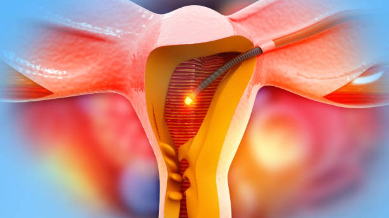 गर्भाशय काढल्यानंतर महिलांच्या शरीरात कोणते बदल होतात? गर्भाशयासंबंधित गंभीर समस्या कोणत्या कारणामुळे उद्भवतात