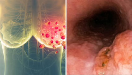 Cancer: पुरुषांना ओरल आणि महिलांना ब्रेस्ट कॅन्सर अधिक, कसे वाचू शकाल? 5 टिप्स देऊ शकतात मुक्ती