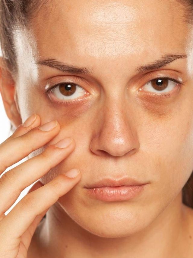 घरगुती पदार्थांनी डोळ्याखालील डार्क सर्कल्स घालवा 