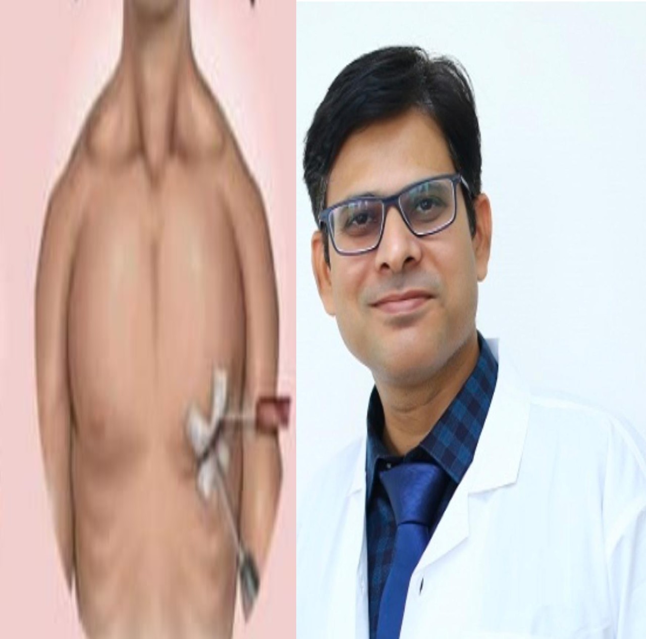 मुंबईत हृदय शस्त्रक्रियेत नवा मैलाचा दगड- मिनिमल इनवेसिव्ह पद्धतीने पाच ग्राफ्ट्स यशस्वी