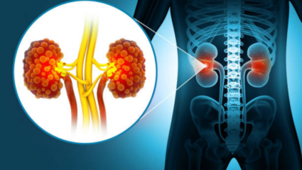 दारू नाही तर ‘या’ 1 पेयाने सडू शकते Kidney, AIIMS च्या डॉक्टरांनी दिला इशारा