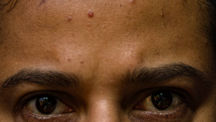 कपाळावर तीळ असणे शुभ की अशुभ? धनसंपत्तीशी काय आहे संबंध; योग्य आणि सटीक अर्थ