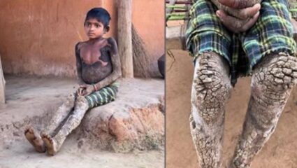 वैद्यकीय विश्वालाही आव्हान! छत्तीसगढमधील 14 वर्षांच्या मुलीचं शरीर बनत चाललंय दगड, या दुर्मिळ रोगाचं नक्की नाव काय?