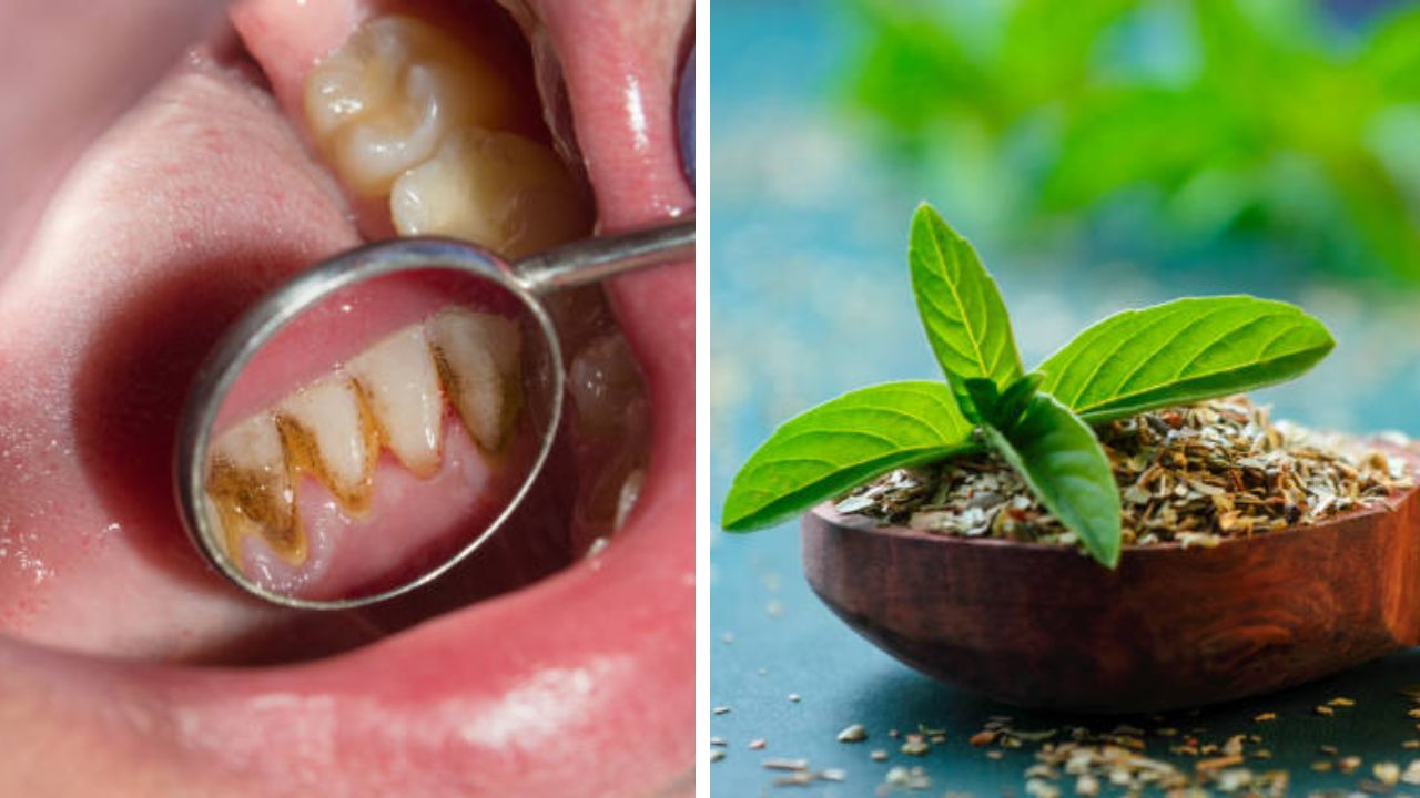 दातांमध्ये साचलेली कीड निघेल बाहेर, आयुर्वेदिक डॉक्टरांनी सांगितले 5 देसी उपाय; तोंडातील दुर्गंधी-रक्तस्त्रावही होईल दूर