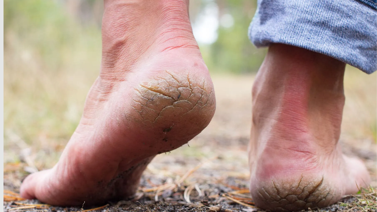 Winter Special: पायाच्या टाचण्यांना पडतायत भेगा? ‘हे’ घ्या टिप्स, वेळ निघून जाण्याच्या अगोदरच करा उपाय