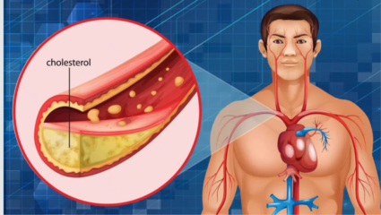 बाहेरून फिट पण आतून नसा ब्लॉक तर होत नाहीत? हाय कोलेस्टेरॉलची लक्षणे जाणून घ्या