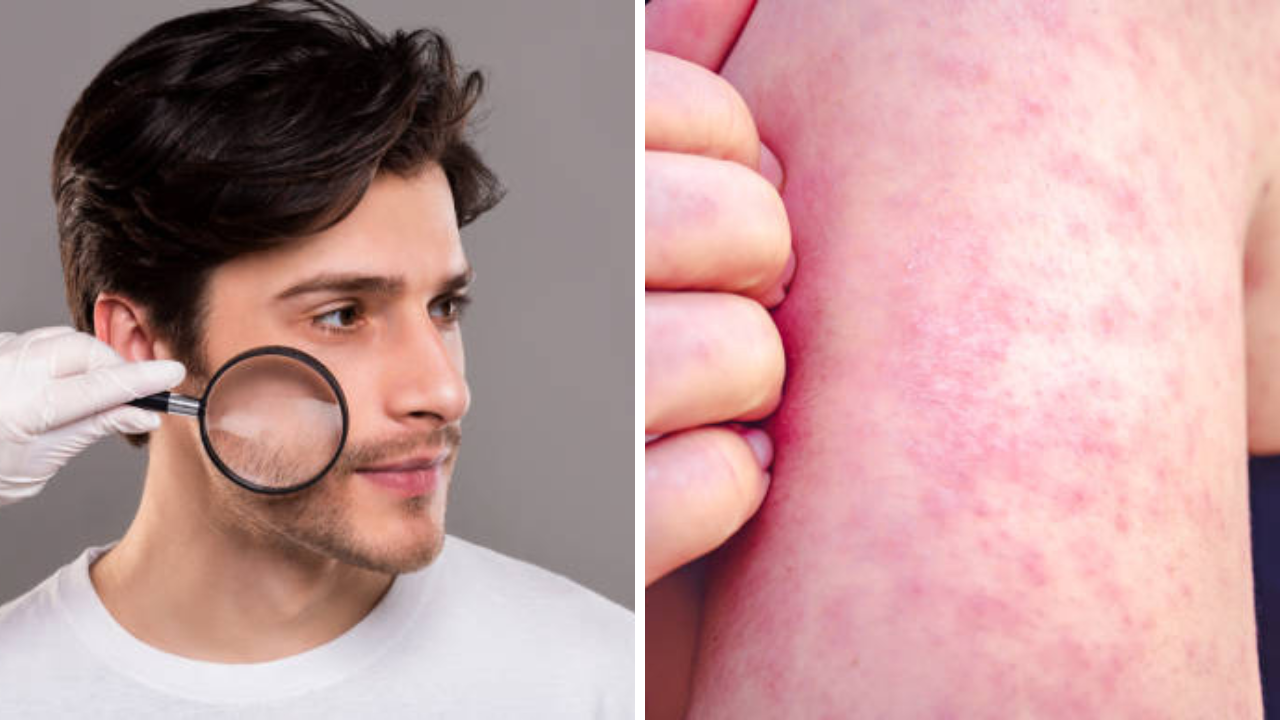मुंबईतील 50% कॉर्पोरेट कर्मचाऱ्यांना सतावतेय त्वचेची समस्या, कारणं वाचून डोक्याला लावाल हात