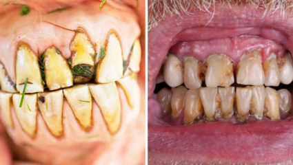 Yellow Teeth Home Remedies: हळद-लवंगसह घरीच बनवा Herbal Tooth Powder, दातावरील पिवळा थर होईल गायब