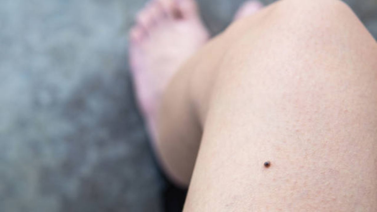 Astro Tips: गुडघ्यावर तीळ असणे शुभ की अशुभ, जाणून घ्या