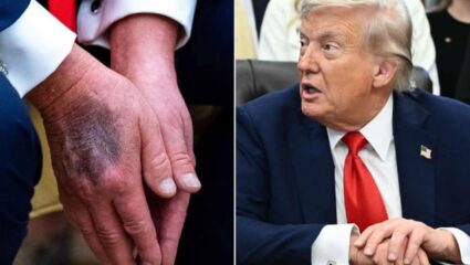 White House : ‘मी डॉक्टरांचं ऐकत नाही!’ Donald Trump घेत आहेत अ‍ॅस्पिरिनचा ओव्हरडोस; नक्की काय आहे कारण?