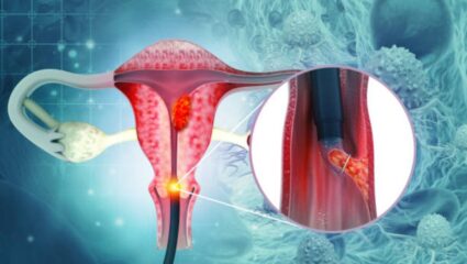 महिलांमध्ये का वाढतंय Cervical Cancer चे प्रमाण? गर्भाशयमुखाचा कॅन्सर होण्यास कारणीभूत ठरतात ‘या’ चुकीच्या सवयी