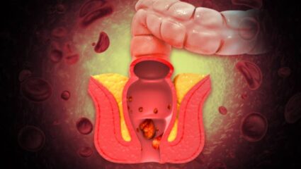 नाजूक जागी वाढलेला मूळव्याध मुळांपासून होईल नष्ट! तीव्र वेदनांपासून आराम मिळवण्यासाठी फॉलो करा ‘या’ सोप्या टिप्स