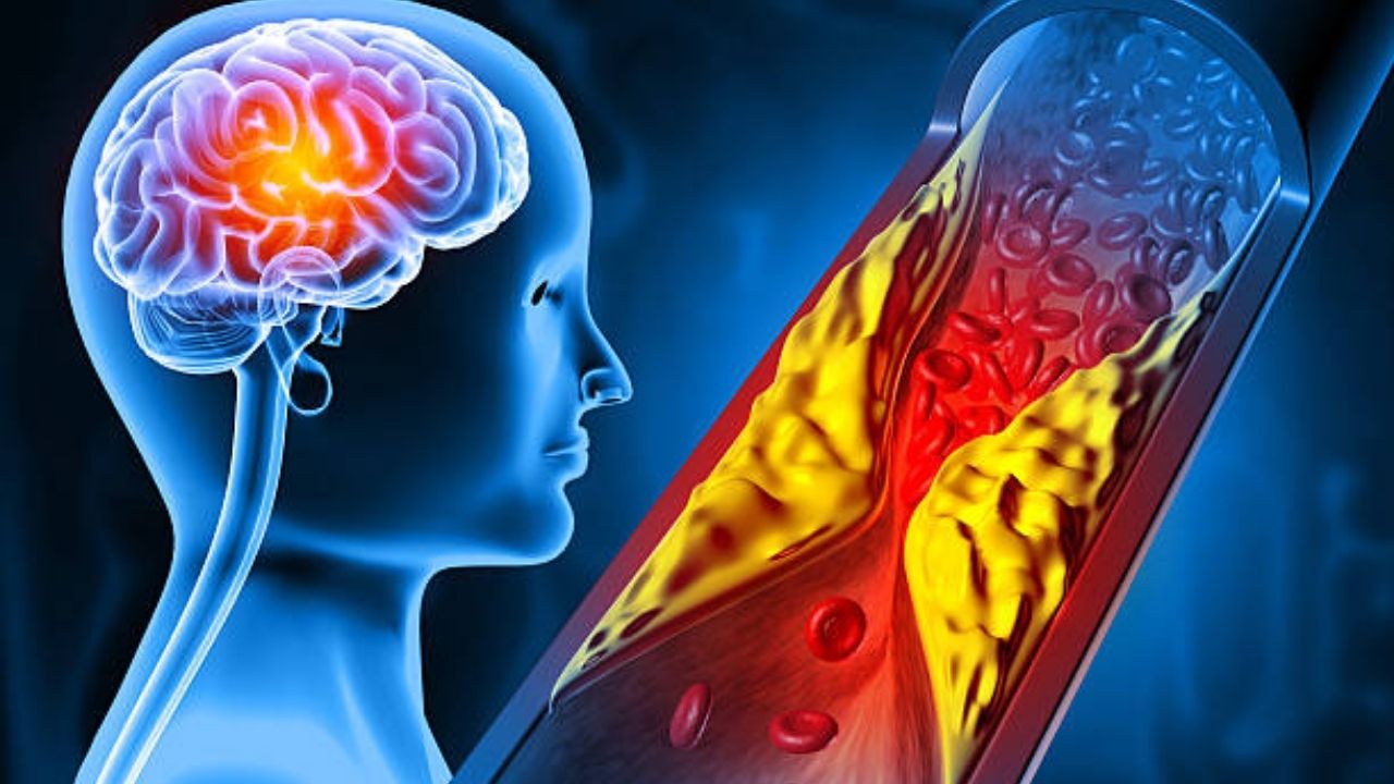 रक्तवाहिन्यांमध्ये घाणेरडे कोलेस्ट्रॉल वाढल्यानंतर चेहऱ्यावर दिसून येतात ‘ही’ लक्षणे, दुर्लक्ष केल्यास कोणत्याही क्षणी येईल हार्ट