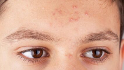 शरीरातील ‘या’ लहान मोठ्या अवयवांमध्ये बिघाड झाल्यानंतर चेहऱ्यावर सतत येतात पिंपल्स, जाणून घ्या यावरील घरगुती उपाय