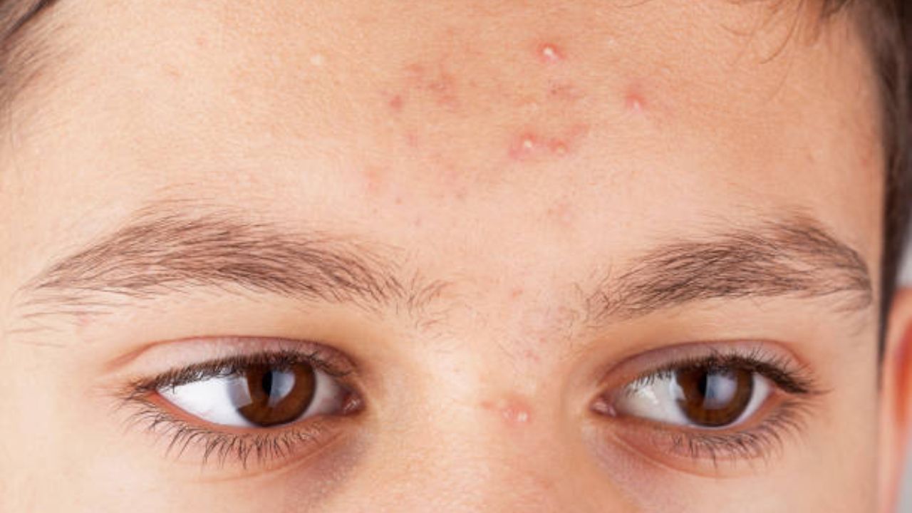 शरीरातील ‘या’ लहान मोठ्या अवयवांमध्ये बिघाड झाल्यानंतर चेहऱ्यावर सतत येतात पिंपल्स, जाणून घ्या यावरील घरगुती उपाय