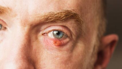 ‘म्युकस फिशिंग सिंड्रोम’ म्हणजे नेमकं काय? डोळ्यांच्या आरोग्याला धोका निर्माण झाल्यास दृष्टीवर होऊ शकतो परिणाम