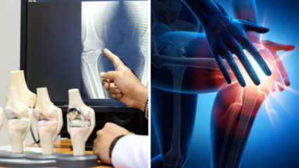अंशतः गुडघे प्रत्यारोपण ठरतेय Osteoarthritis च्या रुग्णांसाठी वरदान, गुडघेदुखीवर संपूर्ण गुडघा बदलण्याची गरज नाही भासणार