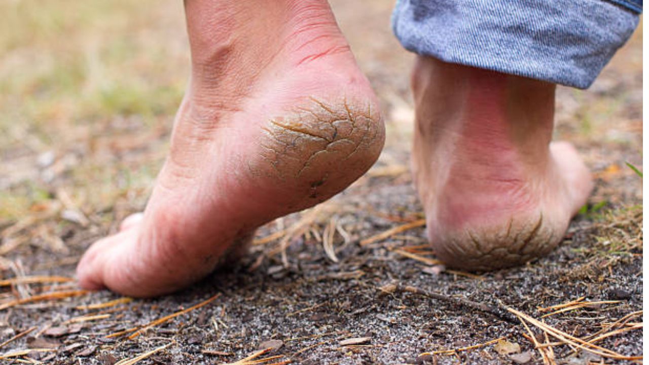 भेगा पडलेल्या टाचांना एका रात्रीतच बरं कसं करायचं? घरच्या घरी या सोप्या उपायाने टाचांना बनवा मऊ