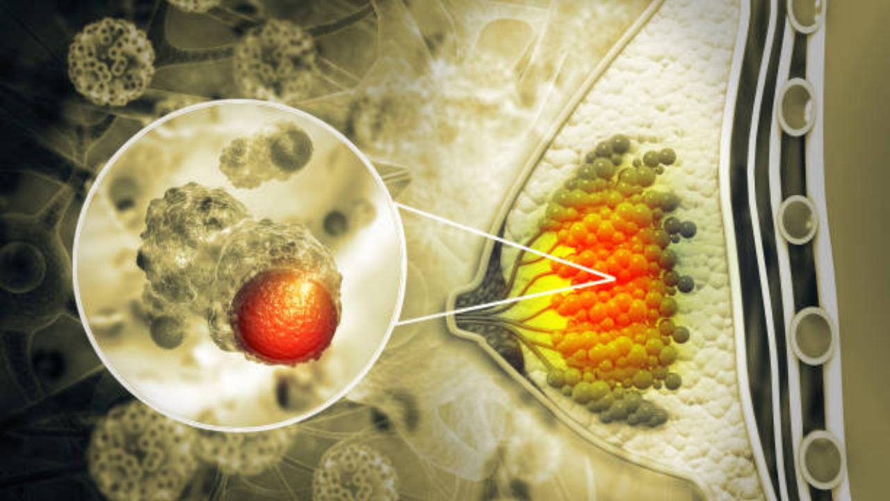 World Cancer Day 2026: भारतातील Breast Cancer वर 4 उपचारपद्धती, जगण्याची शक्यता वाढवण्यास करतील मदत